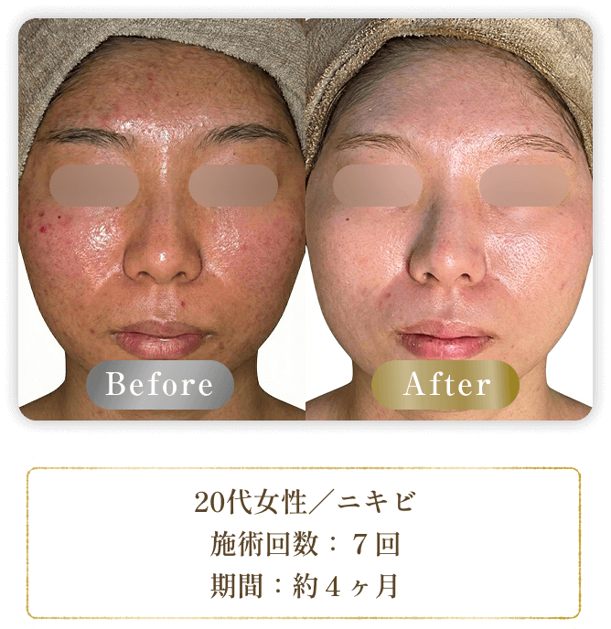 20代女性／ニキビ 施術回数：７回 期間：約４ヶ月